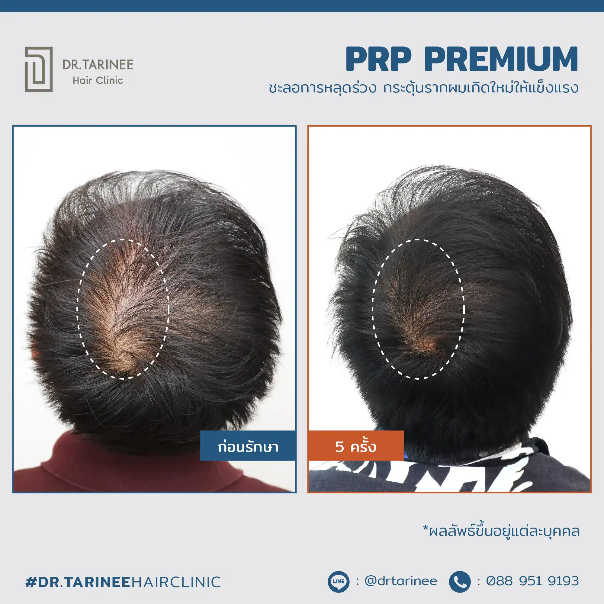 ผลลัพธ์ที่ได้จากการฉีด PRP ผม