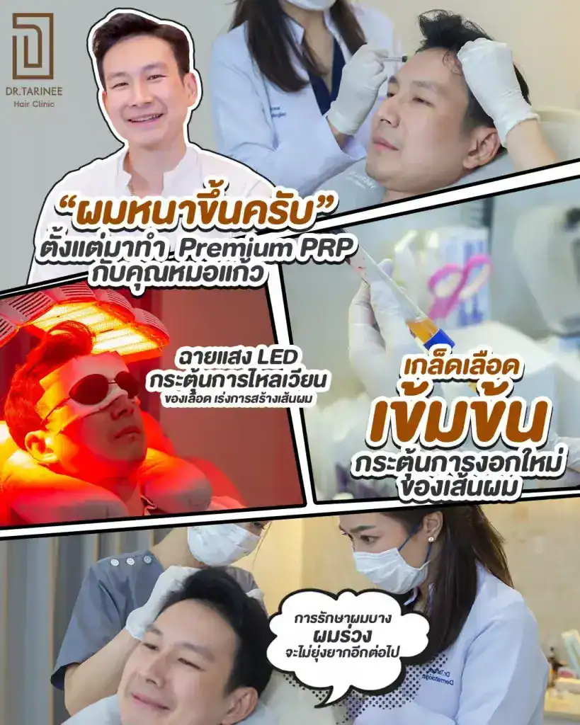ฉีด PRP ผม คือ