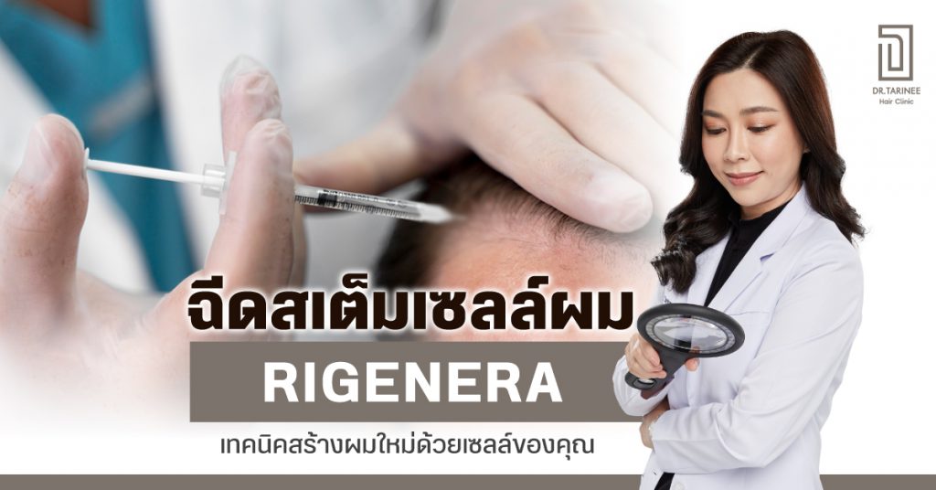 ฉีดสเต็มเซลล์ผม Rigenera คืออะไร