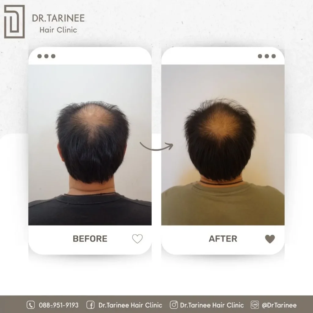 รีวิวเลเซอร์ LLLT