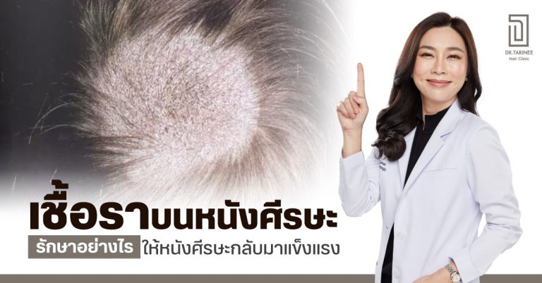 เชื้อราบนหนังศีรษะ รักษาอย่างไร ให้หนังศีรษะกลับมาแข็งแรง