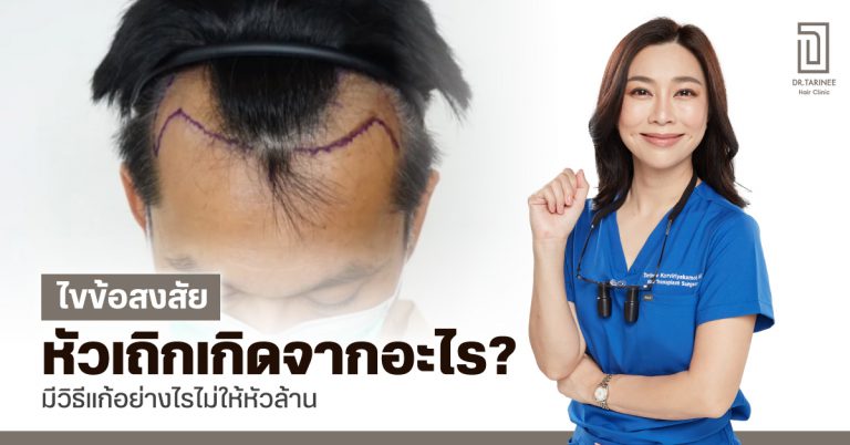 ไขข้อสงสัย หัวเถิกเกิดจากอะไร? มีวิธีแก้อย่างไรไม่ให้หัวล้าน