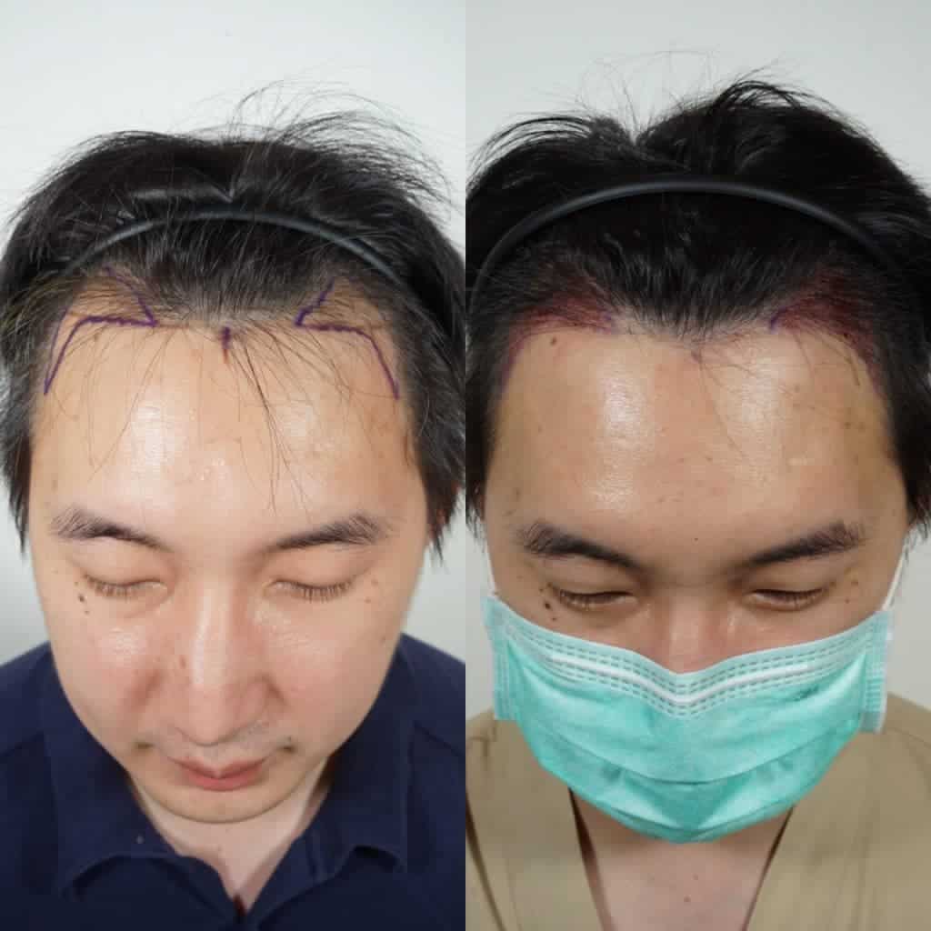 ปลูกผม ผลลัพธ์