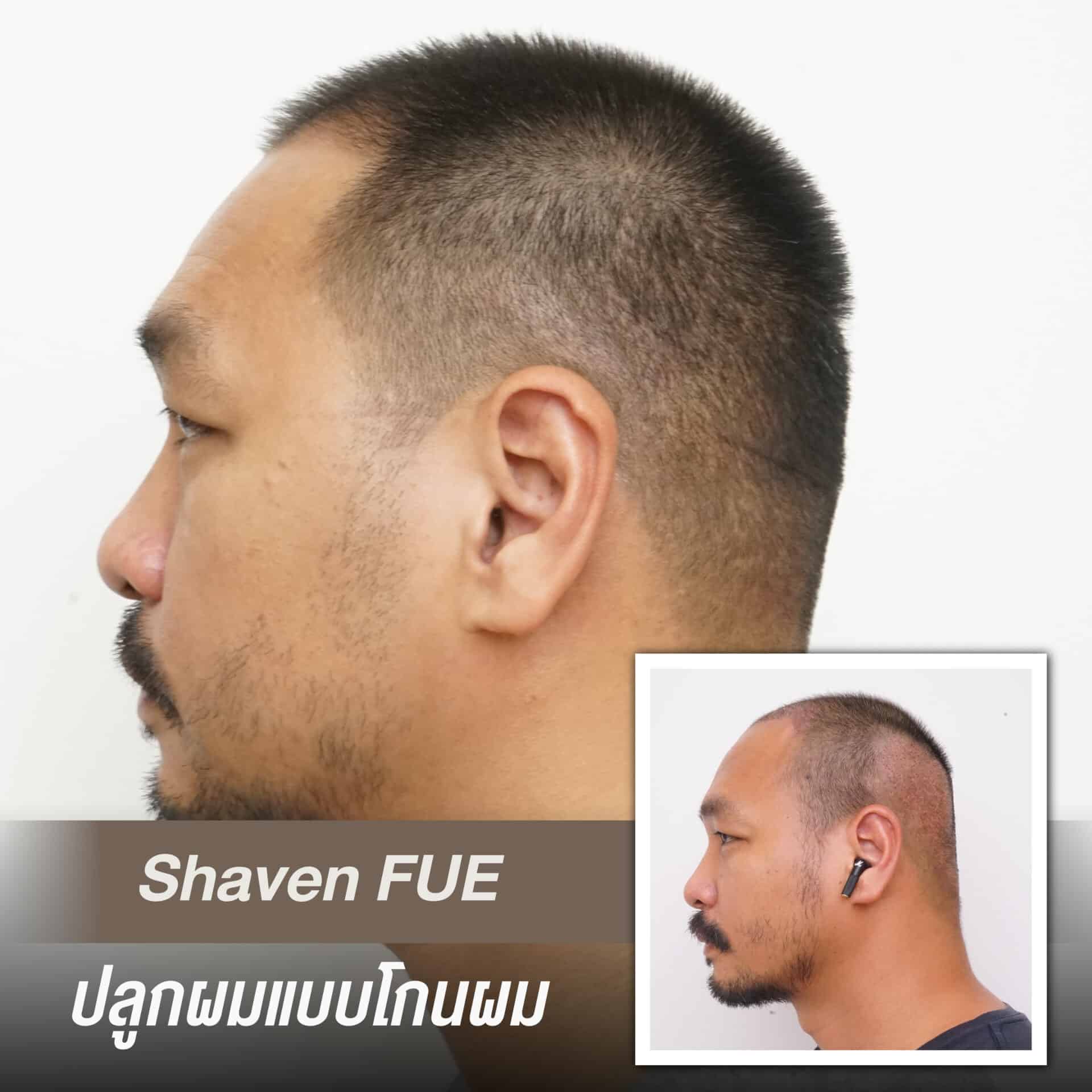บริการ Shaven FUE