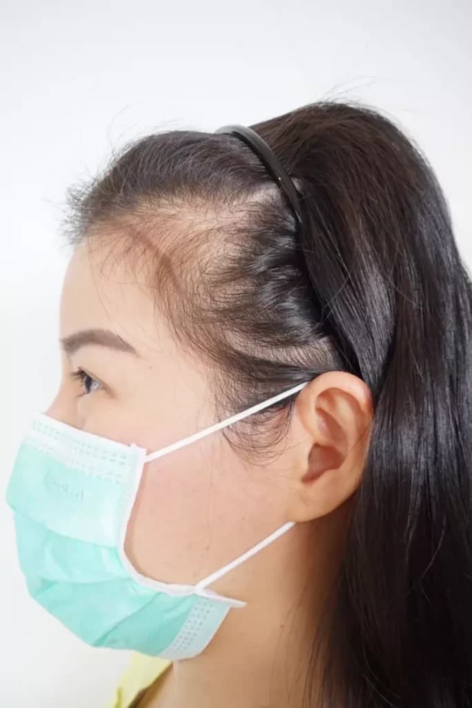 รีวิวก่อนปลูกผม FUE