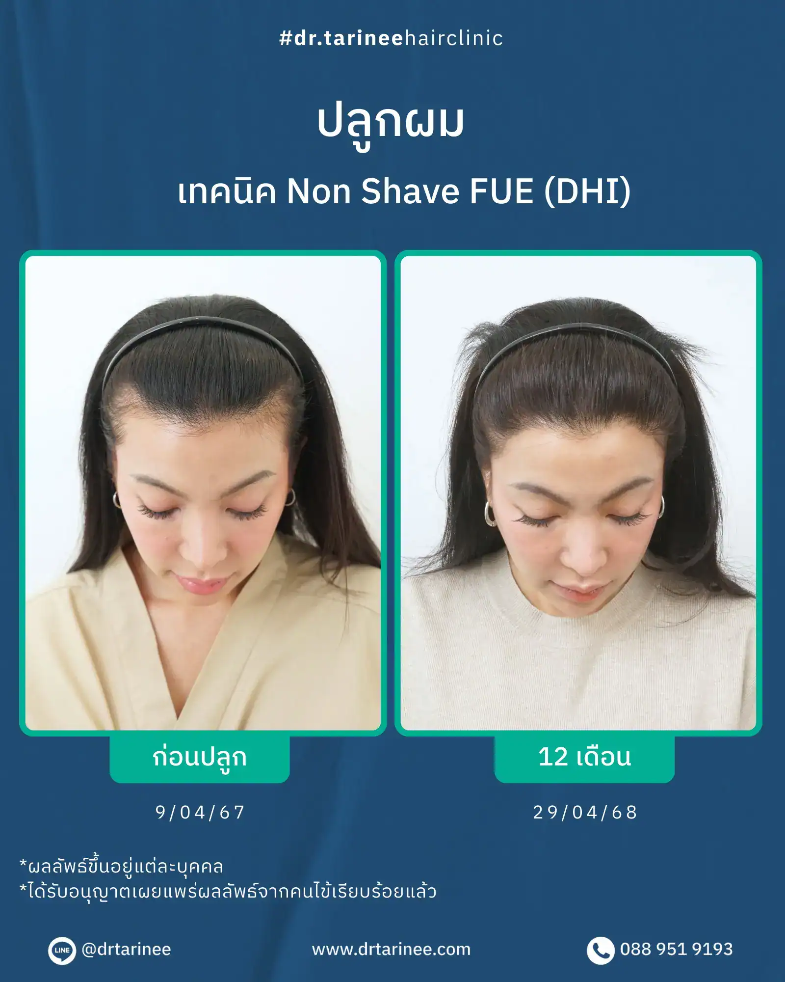 รีวิวปลูกผมผู้หญิง