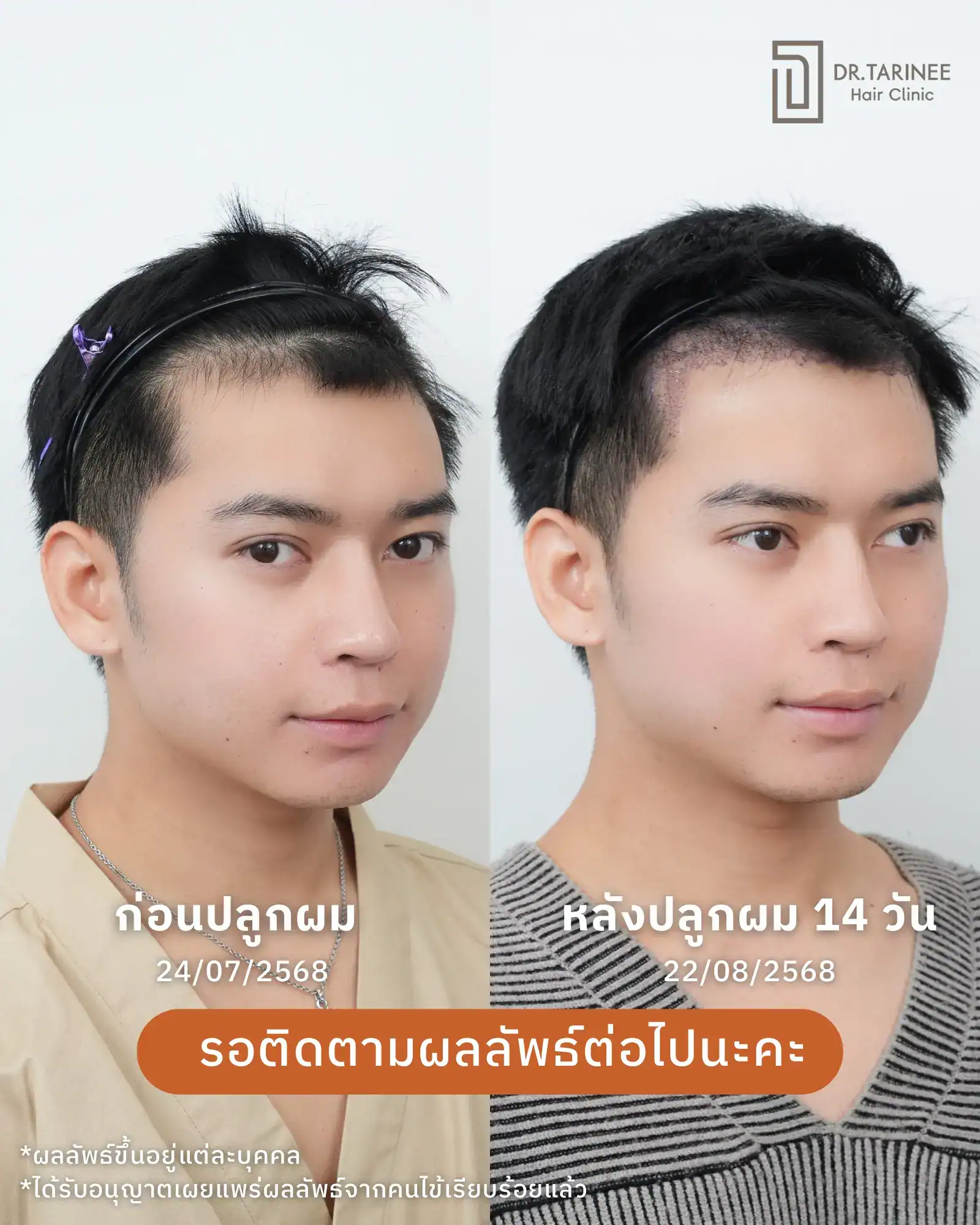 รีวิวปลูกผม