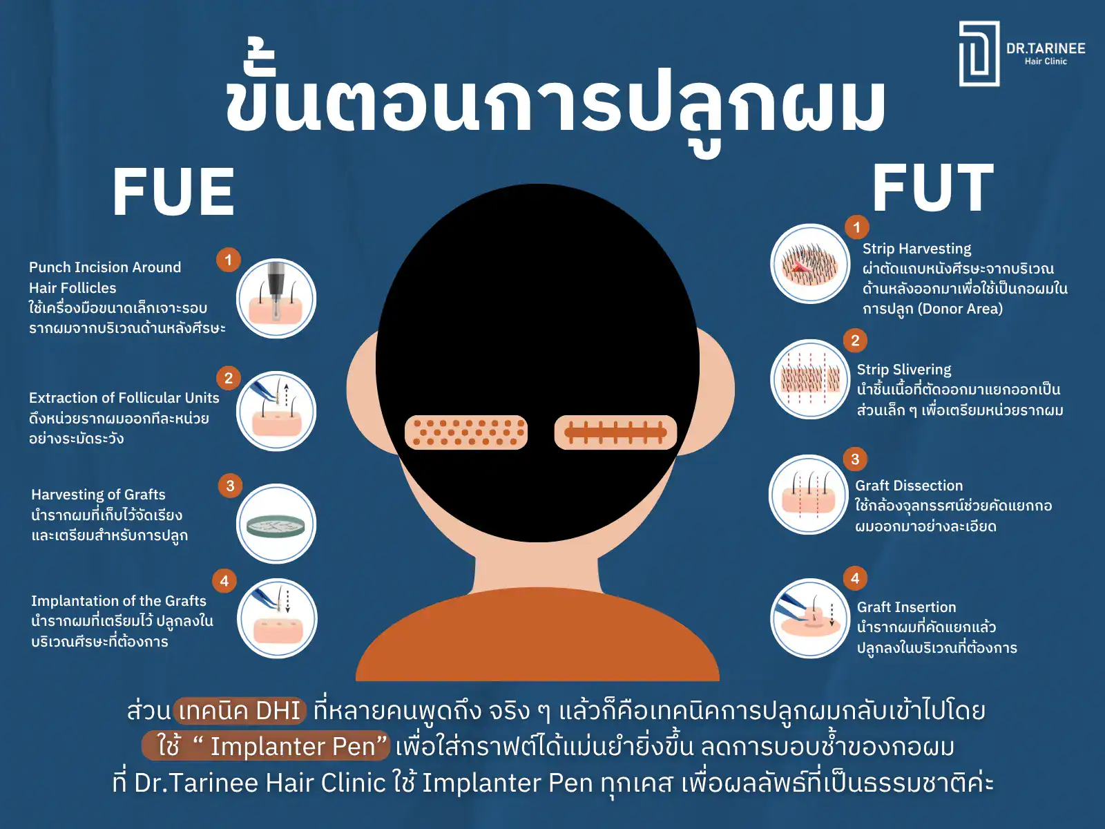 วิธีปลูกผม