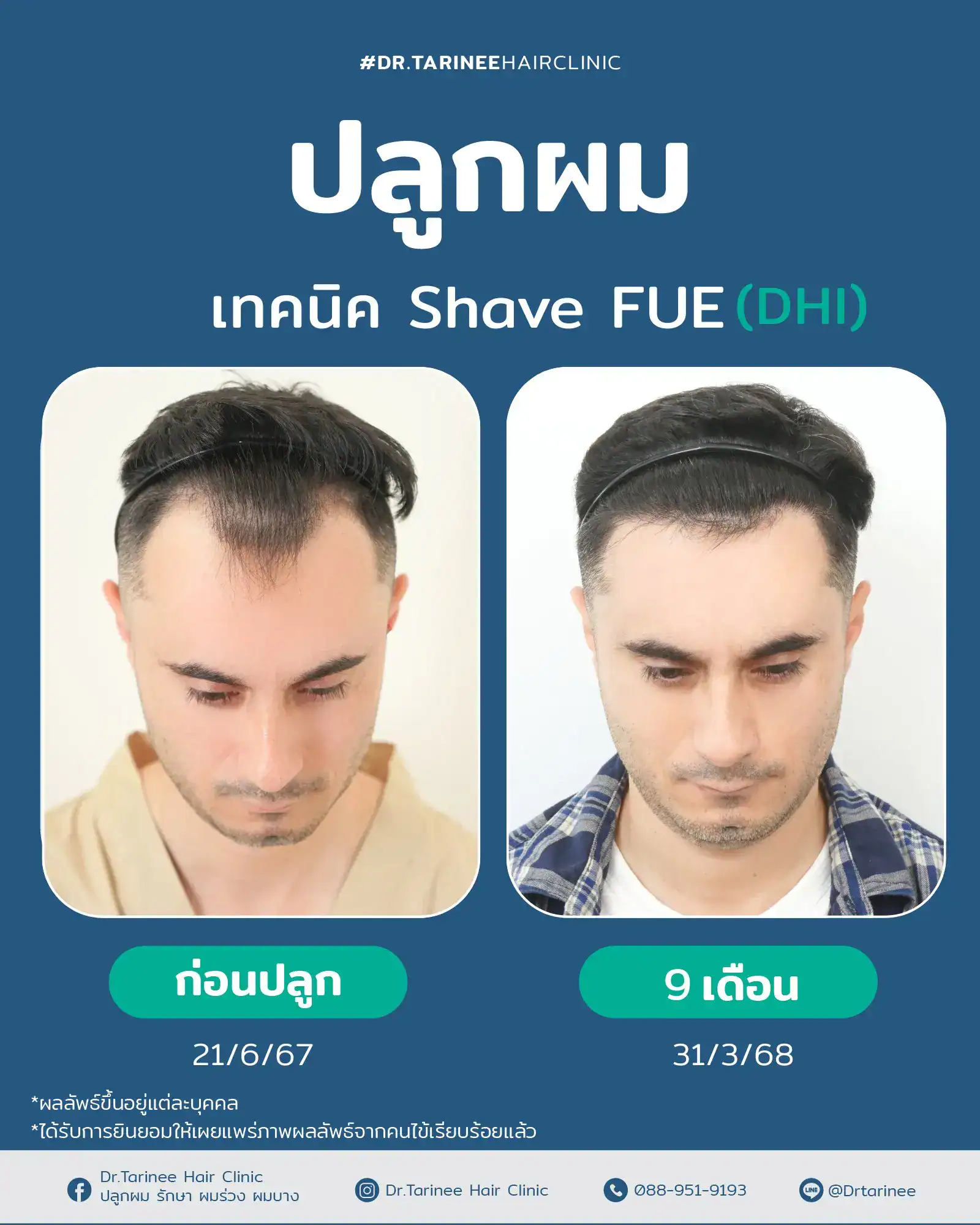 รีวิวปลูกผมผู้ชาย