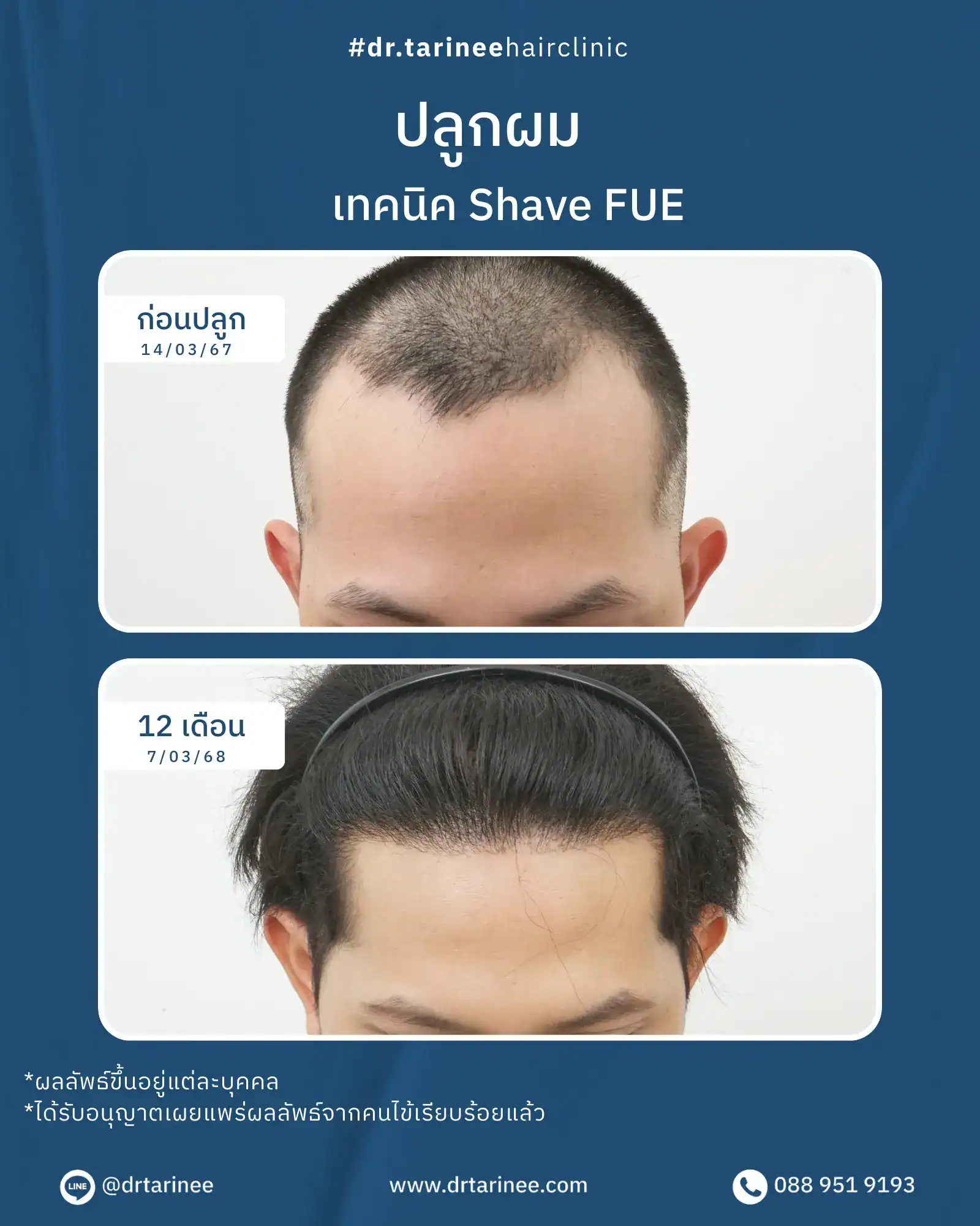 รีวิวปลูกผม FUE