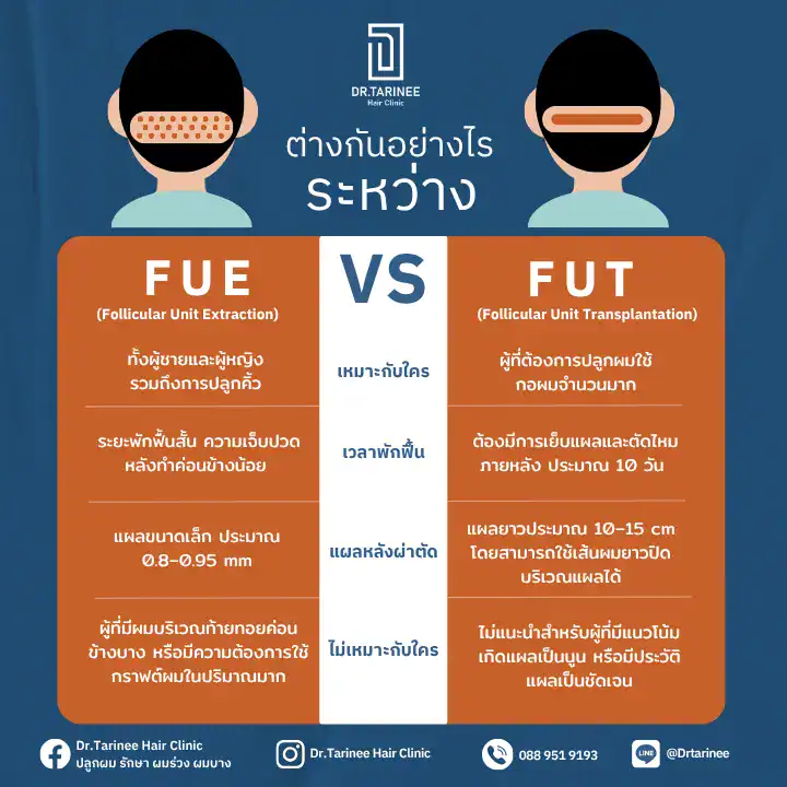 ปลูกผมแบบไหนดี