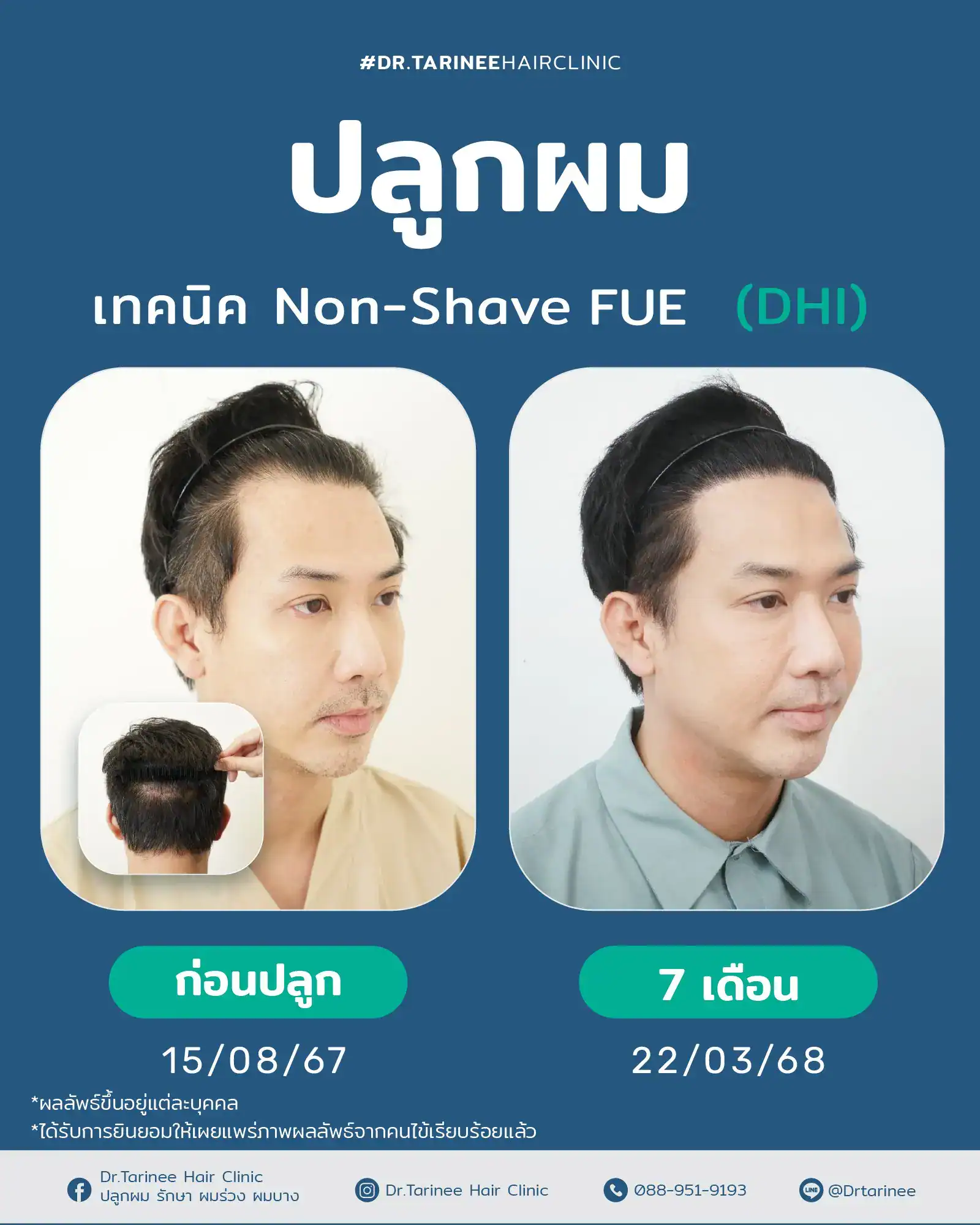 ปลูกผมผู้ชาย คืออะไร?